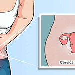 Cervical Cancer: Awareness Is The Key